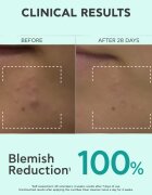 Apivita Just Bee Clear Purifying Cleanser Gel čistilni gel za obraz proti aknam 200 ml
