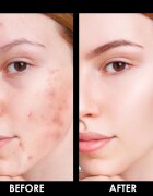 Arval Puractiva Acness čistilni balzam 30 ml