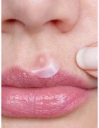 breakout + aid Emergency Dots For Spots and Blemishes lokalna nega proti aknam za obraz dekolte in hrbet s Tea Tree olji 72 kos