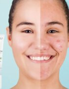 Dermedic Normacne Therapy lokalna nega proti aknam 15 g