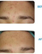 Dermedic Redness Calm krema proti rdečici in razširjenim venam 40 ml