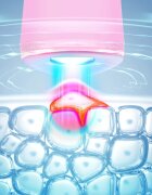 FOREO ESPADA™ 2 pero z modro lučko za pomirjenje pojava aken Pearl Pink 1 kos