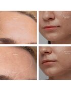 FOREO KIWI™ Derma naprava za diamantno mikrodermabrazijo in čiščenje por 1 kos
