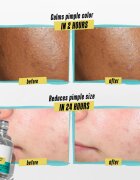 Kiehl's Dermatologist Solutions Truly Targeted Blemish-Clearing Solution serum za aknasto kožo za ženske 15 ml