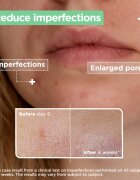 MIXA Anti-Imperfection serum za problematično kožo akne 30 ml