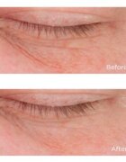 Perricone MD Cold Plasma Plus+ Eye Cream hranilna krema za predel okoli oči proti oteklinam in temnim kolobarjem 15 ml