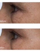 Perricone MD Cold Plasma Plus+ Eye Cream hranilna krema za predel okoli oči proti oteklinam in temnim kolobarjem 15 ml