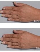 Perricone MD Cold Plasma Plus+ Hand Therapy negovalna krema za roke 59 ml