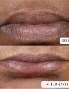 Perricone MD Cold Plasma Plus+ Lip Therapy hranilni in vlažilni balzam za ustnice 4 ml