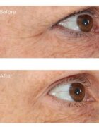 Perricone MD Essential Fx Acyl-Glutathione Eyelid Lift Serum lifting serum za predel okoli oči 15 ml