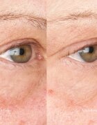 Perricone MD Hypoallergenic Clean Correction Eye Cream vlažilna in posvetlitvena nega za veke in kolobarje pod očmi 15 ml
