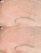 StriVectin Anti-Wrinkle SD Advanced Plus koncentrirana krema za redukcijo gub 118 ml