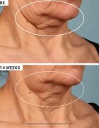 StriVectin Tighten & Lift TL Advanced Tightening Neck Cream Plus učvrstitvena lifting krema za vrat in dekolte 30 ml