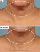 StriVectin Tighten & Lift TL Advanced Tightening Neck Cream Plus učvrstitvena lifting krema za vrat in dekolte 50 ml