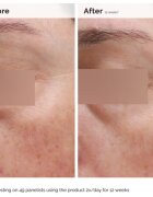 The Ordinary Niacinamide 5% Face & Body Emulsion lahka vlažilna emulzija proti temnim madežem za obraz in telo 100 ml
