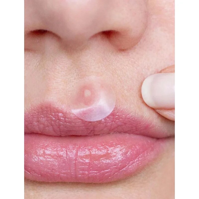 breakout + aid Emergency Dots For Spots and Blemishes lokalna nega proti aknam za obraz dekolte in hrbet s Tea Tree olji 72 kos