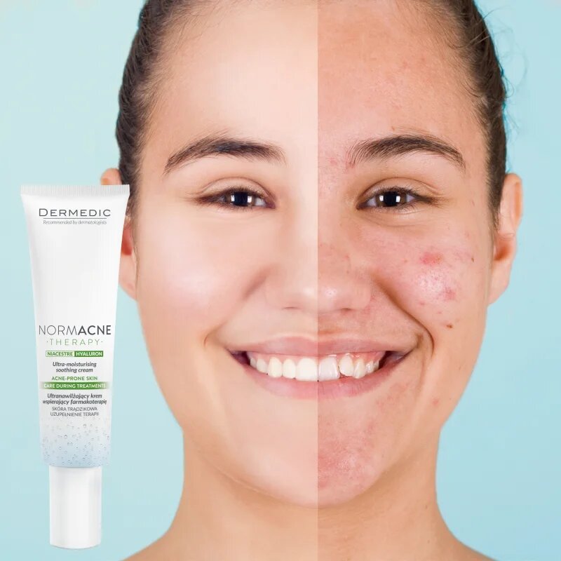 Dermedic Normacne Therapy vlažilna krema za aknasto kožo 40 ml