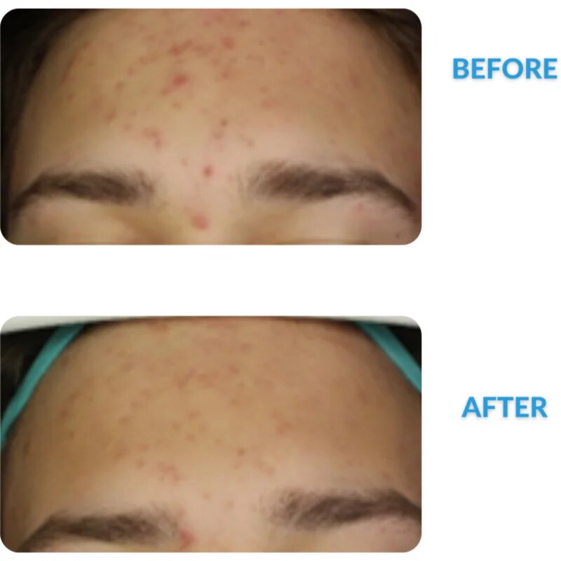 Dermedic Redness Calm krema proti rdečici in razširjenim venam 40 ml