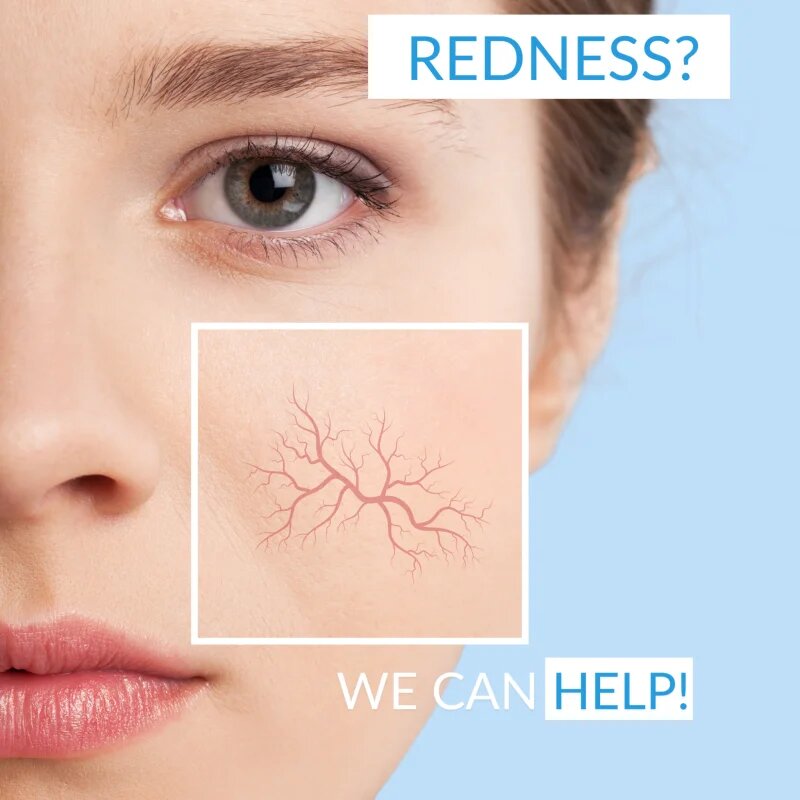 Dermedic Redness Calm pomirjevalna čistilna pena 150 ml