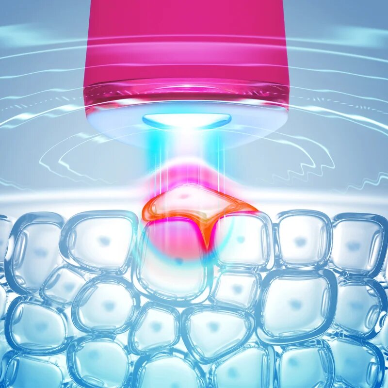 FOREO ESPADA™ 2 pero z modro lučko za pomirjenje pojava aken Fuchsia 1 kos