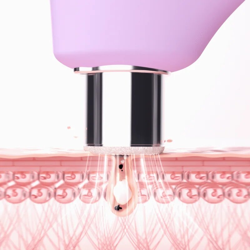 FOREO KIWI™ Derma naprava za diamantno mikrodermabrazijo in čiščenje por 1 kos
