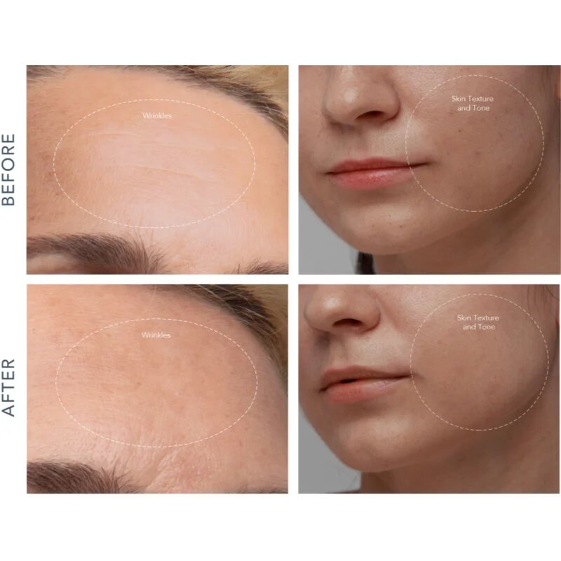 FOREO KIWI™ Derma naprava za diamantno mikrodermabrazijo in čiščenje por 1 kos