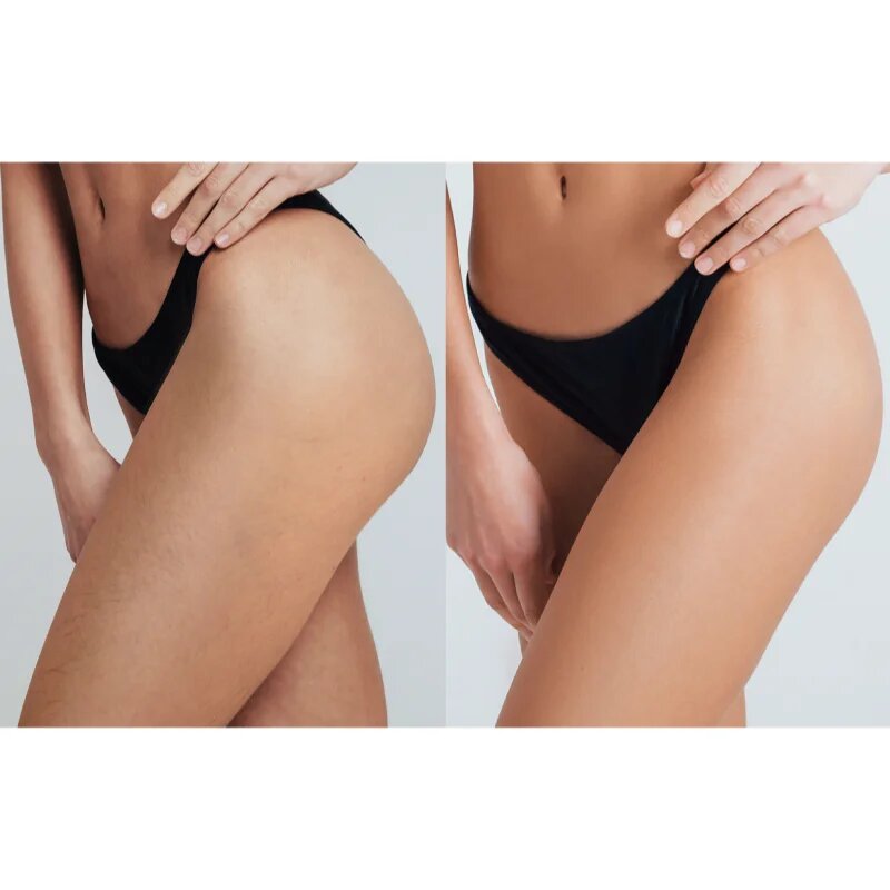 FOREO PEACH™ 2 Pro Max IPL za telo obraz predel bikinija in pazduhe za ženske 1 kos