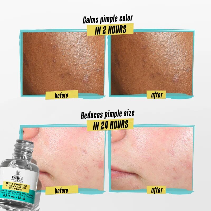 Kiehl's Dermatologist Solutions Truly Targeted Blemish-Clearing Solution serum za aknasto kožo za ženske 15 ml