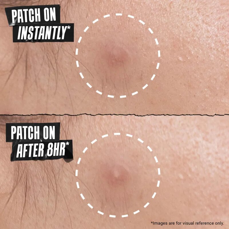 Kiehl's Truly Targeted Overnight Blemish Patch obliži za problematično kožo za ženske 22 kos