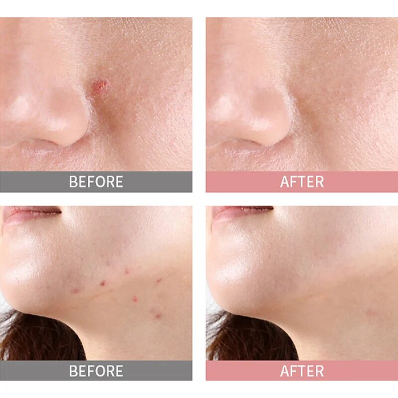 Mizon Good Bye Blemish Pink Spot lokalni serum s pudrom proti aknam 19 ml