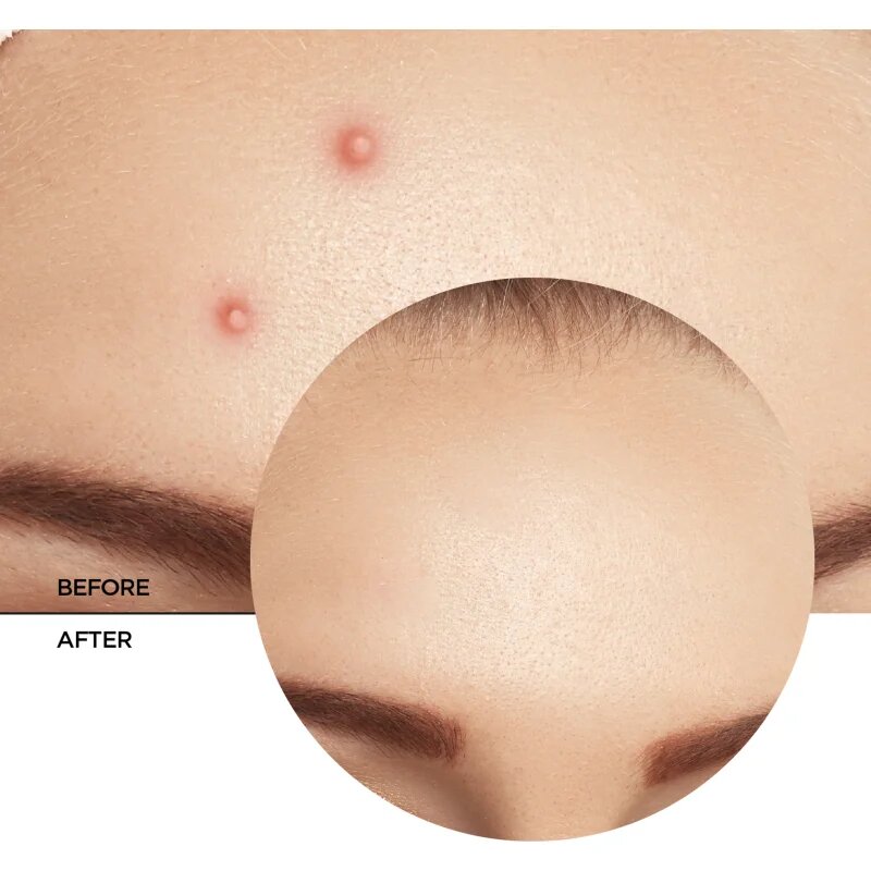 Revox B77 Zitcare AHA BHA PHA Spot Treatment lokalna nega proti aknam 25 ml
