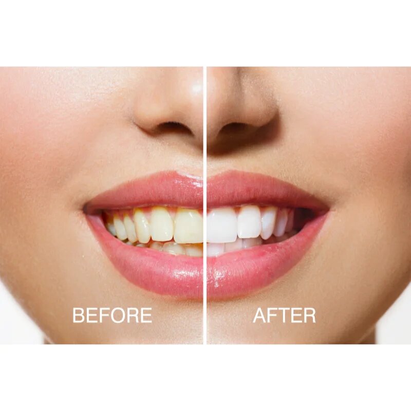 RIO USB teeth whitening set za beljenje zob