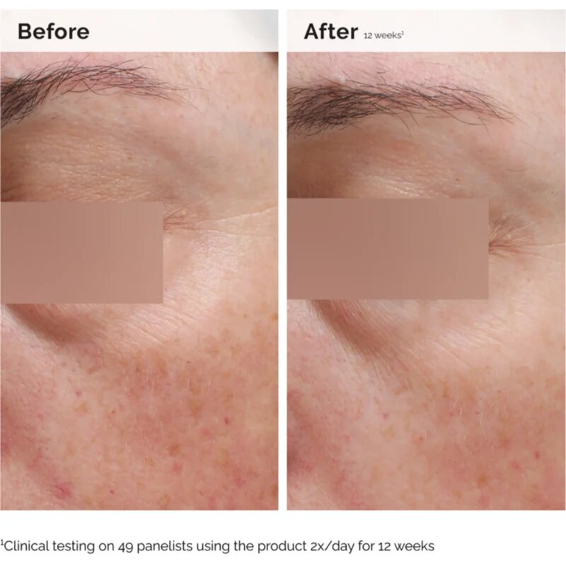 The Ordinary Niacinamide 5% Face & Body Emulsion lahka vlažilna emulzija proti temnim madežem za obraz in telo 100 ml