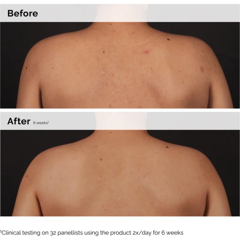 The Ordinary Salicylic Acid 0.5% Body Serum izpopolnjevalni serum za telo s salicilno kislino 240 ml