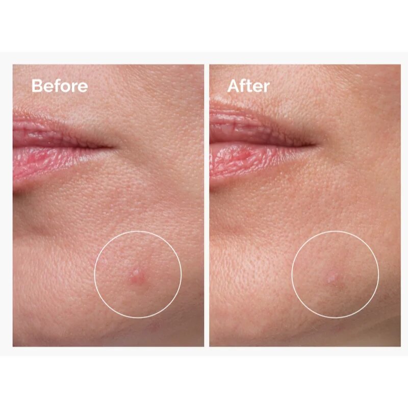 The Ordinary Sulfur 10% Powder-to-Cream Concentrate lokalna nega proti aknam 5 g